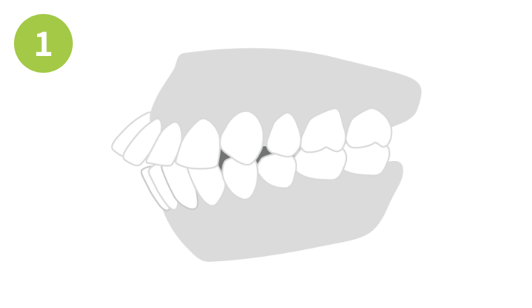 出っ歯の場合画像1