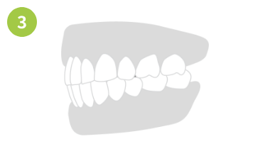 出っ歯の場合画像3