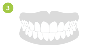 ガタガタした歯並びや八重歯の場合画像3