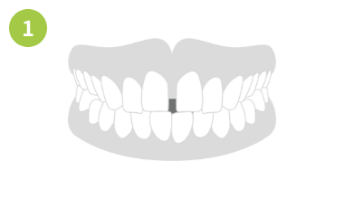 すきっ歯の場合画像1