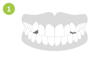 ガタガタした歯並びや八重歯の場合画像1